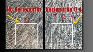 *UPDATE* Verteporfin Possible Hair Loss Cure Clinical Trials