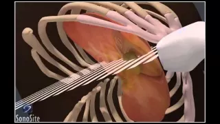 How To: Gallbladder Ultrasound 3D Video