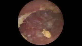 885 - Painful Fungal Infected Keratosis Obturans Removal