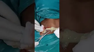 anterior neck abscees. drainage by Dr jalil mujawar