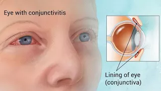 Conjunctivitis || Ophthalmology Videos