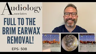 FULL TO THE BRIM EAR WAX REMOVALS - EP508