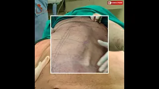 6 Pack Surgery in 1 Minute by Dr. Amit Gupta | Divine Cosmetic Surgery - February 2021