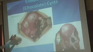 7) Endometriosis/ Adenomyosis 10/11/2020