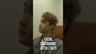 [Plastic Surgery in Korea] Male facial contouring at DA Plastic Surgery 💎