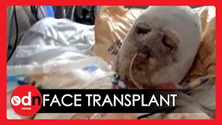 World's First Face and Hand Transplant Surgery Hailed a Success