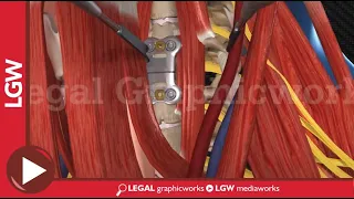 Anterior Cervical Fusion Surgery 3D animation