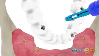 Inseritore estrattore seeger protesi fissa