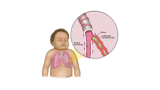 Wheezing in Children: Expert Advice from Dr. Parimala V Thirumalesh | Aster CMI Hospital