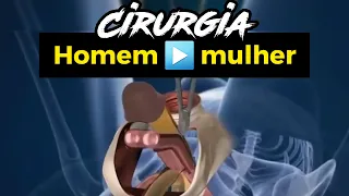 CIRURGIA REDESIGNAÇÃO SEXUAL: Homem 🔴 Mulher