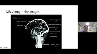 Webinar - CVST Cerebral Venous Sinus Thrombosis with Dr  Michelle Lavin