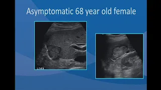 sonography of  Focal Liver Lesions