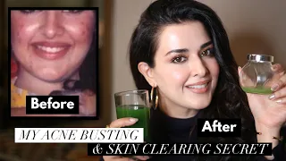 ACNE FIGHTING, SKIN  CLEARING JUICE & SERUM | DIY | BEYOND BEAUTY NATASHA