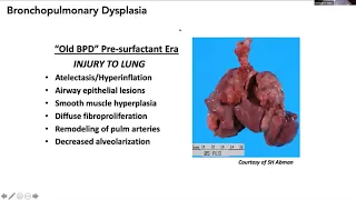 Virtual FTS Pediatric Session: Bronchopulmonary Dysplasia