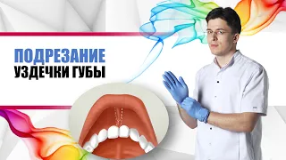 подрезание уздечки губы