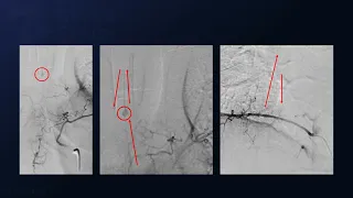 Clip Reconstruction of Ruptured Thoracic Anterior Spinal Artery Aneurysm Using Costotransversectomy