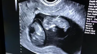 Monochorionic, Diamniotic Twin Pregnancy at 10 weeks gestation!