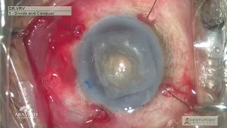 CCS Files - Episdoe 18 - Phacoemulsification in Mature Cataract with Small pupil with Iris Hooks