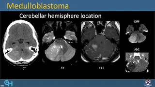 imaging of Pediatric brain tumor