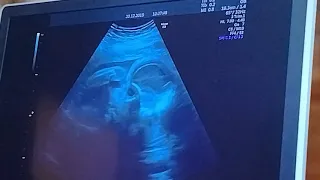 Christmas Prince 3 Royal Baby/ ultrasound