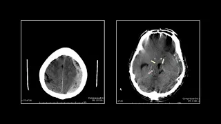 Neuro Trauma II | Interesting Radiology Cases