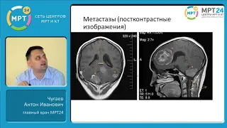МРТ диагностика опухолей головного мозга