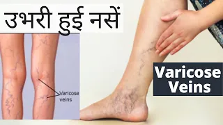 Varicose veins | उभरी हुई नसें | varicose vein  treatment | Spider Veins