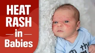Heat Rash in Babies