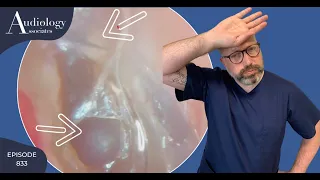 INSECT PUNCTURED "MEMBRANE" REMOVAL/SATISFYING EAR WAX PLUG REMOVAL- EP833