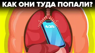 Невероятные предметы, которые врачи извлекали из людей.