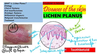 Oral Lichen planus Part 2 - Oral manifestations , Histopathology, Diagnosis & Treatment |