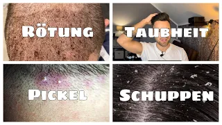 RÖTUNG, TAUBHEIT, PICKEL & SCHUPPEN nach der Haartransplantation - Tipps & Erfahrung für deine HT!