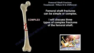 Femoral Shaft Fracture When It Is Different - Everything You Need To Know - Dr. Nabil Ebraheim