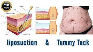 Liposuction For Weight Loss, Surgery Cost, Procedure, Side Effects, Tummy Tuck Abdominoplasty