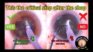 The critical step after phaco chop in cataract surgery