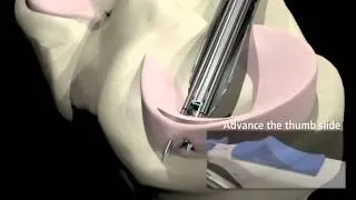 Arthroscopic Meniscus Repair