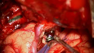 Pterional Craniotomy & Transsylvian Approach for Clipping of a P2 Posterior Cerebral Artery Aneurysm