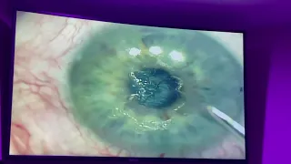 Watch Corneal Scars be Removed in Minutes!