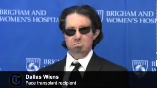 Full face transplant patient speaks out one year on