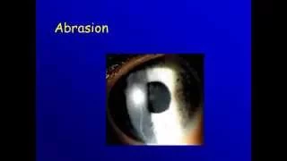 Cornea : 2a Corneal ulcer- Clinical picture