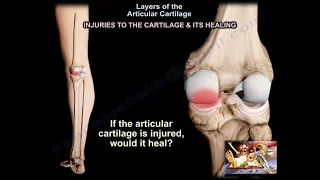 Layers of Cartilage Injuries & Healing- Everything You Need To Know - Dr. Nabil Ebraheim