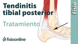 Tendinitis del tibial posterior. Tratamiento con ejercicios de fisioterapia.