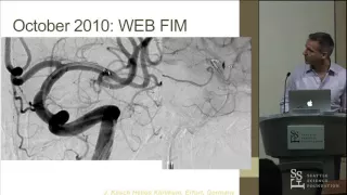 Intrasaccular Flow Diversion and Novel Devices - David Fiorella, MD, PhD