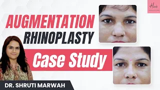 Augmentation Rhinoplasty Case Study | Before and After Results | Handa Aesthetics in Delhi