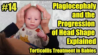 #14 Plagiocephaly and the Progression of Head Shape Explained: Torticollis Treatment in Babies