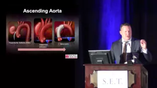 Update of TEVAR for the Ascending Aorta and Aortic Root