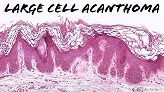 Large Cell Acanthoma: 5-Minute Pathology Pearls