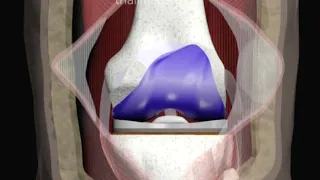 Revision of Knee Replacement Surgery Animation by Cal Shipley, M.D.
