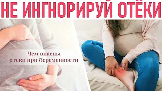 ОТЕКИ ВО ВРЕМЯ БЕРЕМЕННОСТИ | Что делать при отеках