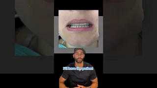 How Invisalign Works: A Case Review. 2023